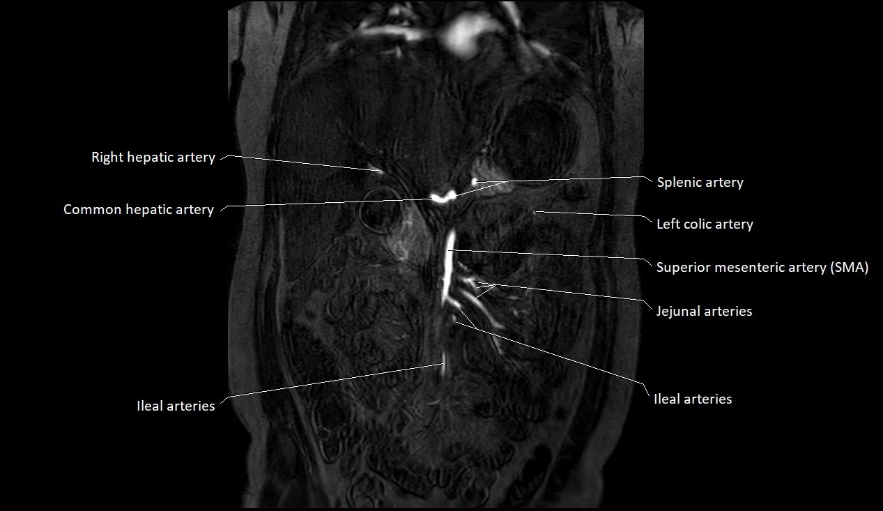 MRA Abdomen coronal anatomy image 6.webp